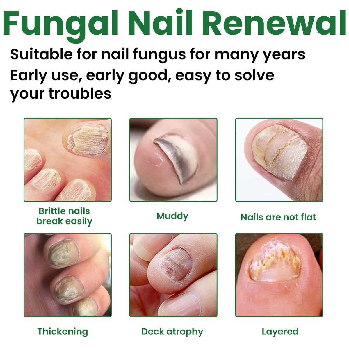 EELHOE Fungal Nail Renewal Treatment Serum – 30ml Antifungal Liquid.