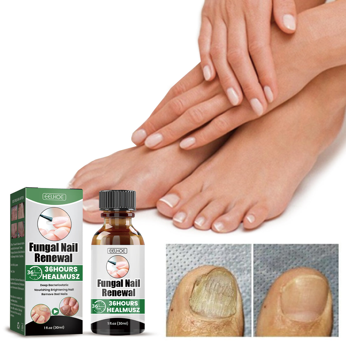 EELHOE Fungal Nail Renewal Treatment Serum – 30ml Antifungal Liquid.